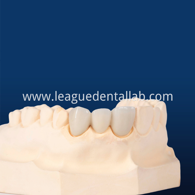 PFM,Metal crown,Fixed metal crown